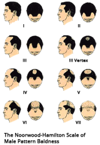 Male Pattern Baldness Scale - Pittsburgh, PA