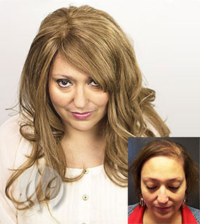 MEP 90 Female Laser Hair Treatment  Pittsburgh PA  Pittsburgh Hair Loss  Replacement Treatment Clinic PA