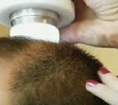 Laser Hair Loss Analysis - Pittsburgh, PA