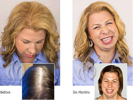Hair Restoration for Men and Women with KeraLase and KeraFactor Pittsburgh  PA